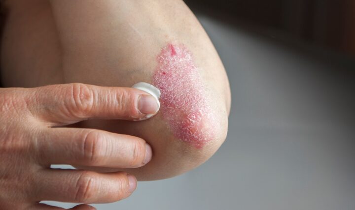 Jak poradzić sobie z łuszczycą?